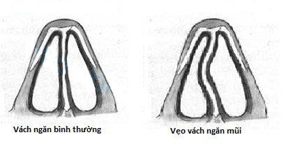 
Hẹp van mũi có thể gây vẹo lệch vách ngăn mũi
