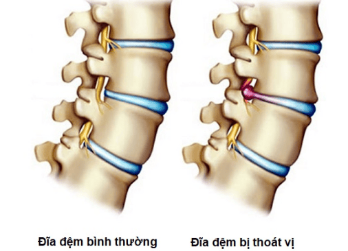 10. Cách Chăm Sóc Sau Điều Trị Thoát Vị Đĩa Đệm