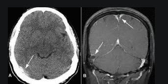 Causes of cerebral venous thrombosis