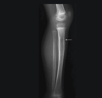 
Ewing sarcoma là bệnh ung thư ở xương chân
