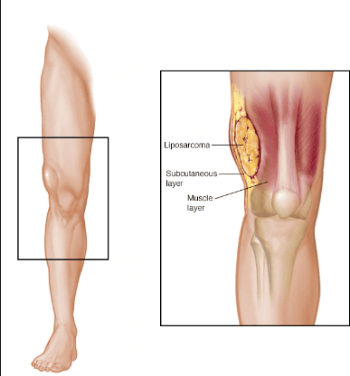 
Liposarcoma là một loại ung thư hình thành trong các mô mỡ của cơ thể
