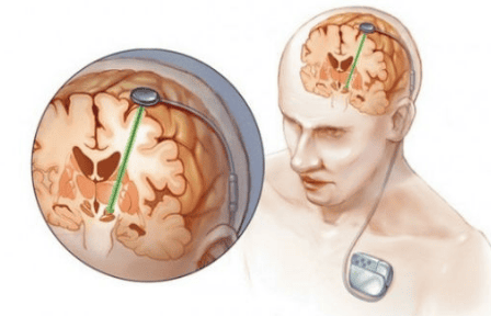 Tìm hiểu về phẫu thuật kích thích não sâu