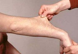 các dạng rối loạn collagen hệ thống trong hội chứng Ehlers-Danlos