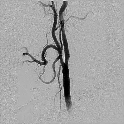 Background erasing digitized aortic angiography