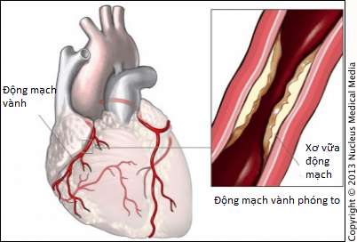 Is spontaneous coronary artery dissection dangerous?