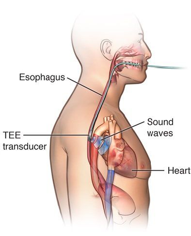 When is a transesophageal echocardiogram needed?