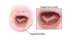 Ankyloglossia: Diagnosis, treatment