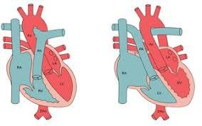 Chuyển vị đại động mạch: Nguyên nhân hình thành