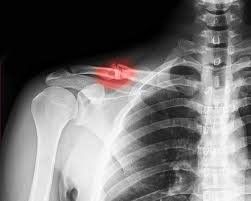 Trường hợp nào mổ lấy nẹp vít xương đòn được chỉ định gây tê đám rối thần kinh cánh tay?