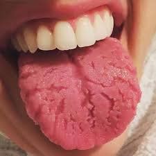 Bị nứt lưỡi khá sâu không đau nhưng hay bị tê rát khi ăn đồ chua, mặn và cafe là bị bệnh gì?