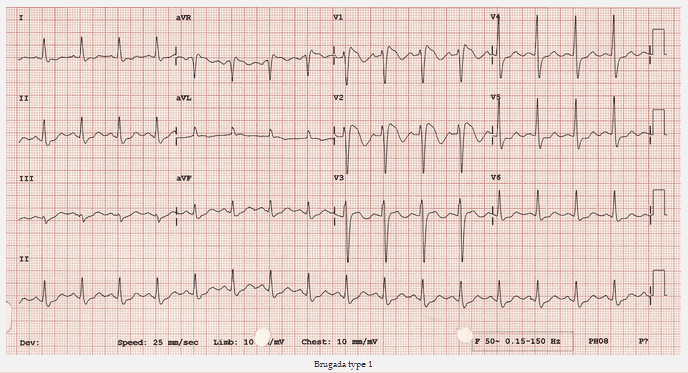 7. Những lưu ý đặc biệt cho người mắc hội chứng Brugada Type 1