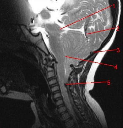 Classification of Chiari malformations