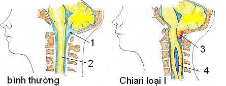 
Dị dạng Chiari type 1
