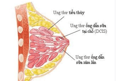 
Ung thư vú dạng viêm là loại ung thư ít gặp
