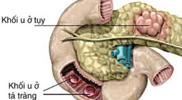 
Mức độ gastrin quá cao có thể do hội chứng Zollinger-Ellison
