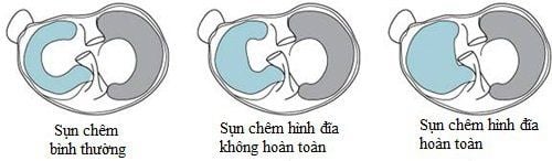 
Hình ảnh các loại sụn chêm đĩa hình
