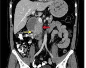 
Hình 3: Hình ảnh ung thư tá tràng trên CT- Scan bụng
