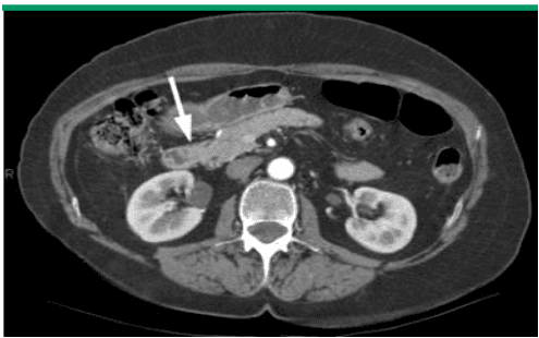 
Hình 3: Hình ảnh u quanh bóng Vater trên CT- Scan bụng
