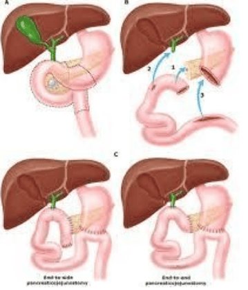 
Hình 8: Kỹ thuật cắt khối tá tuỵ trong điều trị ung thư quanh bóng Vater
