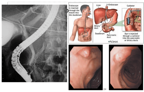 
Hình 4: Hình ảnh nội soi mật tuỵ ngược dòng, cho thấy hình ảnh bình thường quanh bóng Vater.
