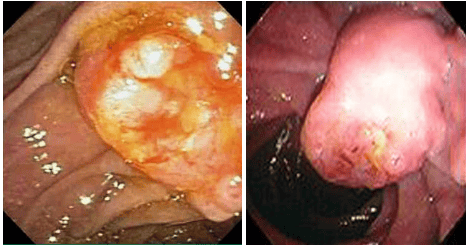 Common lesions around the ampulla of Vater