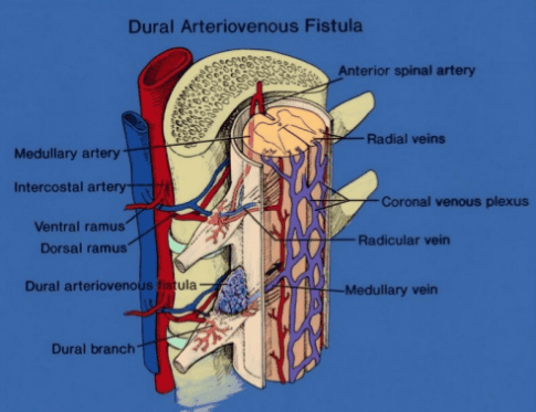 Arteriovenous fistula of spinal cord