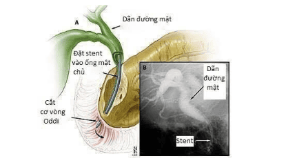 
Minh họa thủ thuật ERCP. Đường mật bị tắt/hẹp tạo nên hình ảnh dãn đường mật phía trên dòng. Ống stent (màu xanh dương) đặt vào ống mật chủ để làm thông đường mật. Hình đen trắng bên phải (hình B) là hình ảnh trên màn hình chụp trong quá trình thực hiện thủ thuật.
