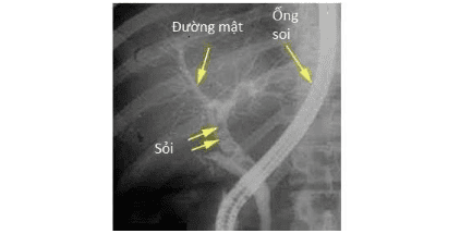 
Hình ảnh X quang chụp các cấu trúc đường mật trong thủ thuật ERCP lấy sỏi mật. Những viên sỏi nằm thành hàng trong ống mật chủ gây tắc đường mật.
