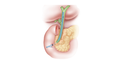 
Stent được đặt trong ống mật chủ
