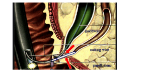 
Kỹ thuật đặt stent ống tuỵ
