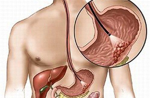 
Bệnh U carcinoid
