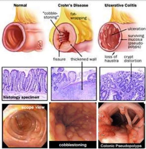 
Hình 1: Hai thể bệnh của bệnh viêm ruột mãn tính: viêm loét đại tràng và bệnh Crohn
