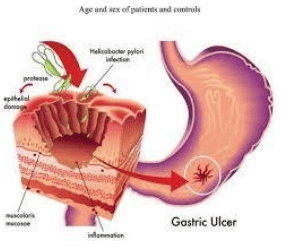 
Loét dạ dày do vi khuẩn H. pylori
