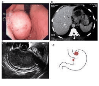 
Hình 4: Hình ảnh u GIST – U trung mô đường tiêu hóa ở phình vị trên nội soi và nội soi siêu âm
