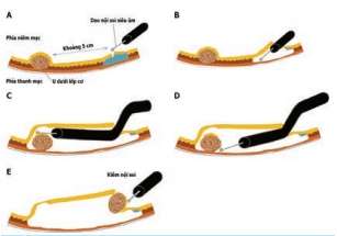 
Hình 7: Cắt bỏ u nội soi qua đường hầm dưới niêm mạc
