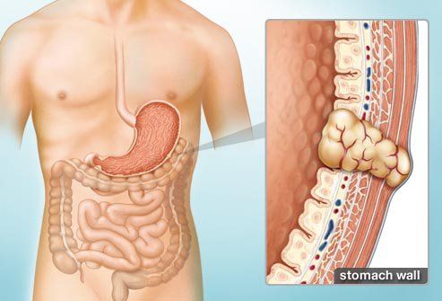 Chẩn đoán và điều trị u dưới niêm đường tiêu hoá