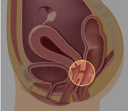 
Hình 4: Dò trực tràng – âm đạo
