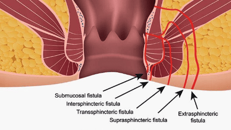 
Hình 7: Bệnh lý rò hậu môn
