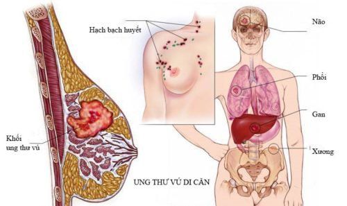 
Các ứng dụng tiềm năng của việc phân tích ctDNA dự đoán nguy cơ tái phát và theo dõi các khối u di căn như ung thư vú
