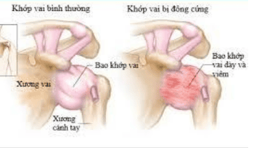 
Tình trạng khớp vai bị đông cứng
