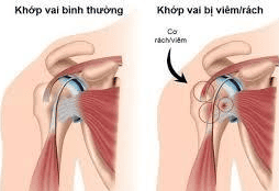 
Viêm quanh khớp vai thể tắc nghẽn có thể được chỉ định dùng thuốc uống hoặc tiêm
