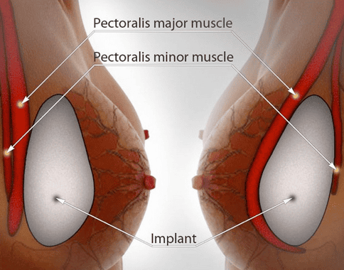 
Hình ảnh chụp X-quang vú có thể bị ảnh hưởng khi thực hiện ở phụ nữ có implant
