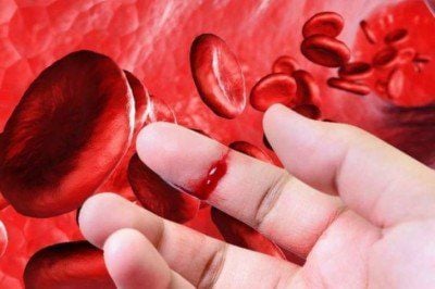 Đánh giá chảy máu ở bệnh nhân Hemophilia