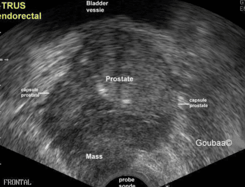 Can ultrasound help detect prostate diseases?