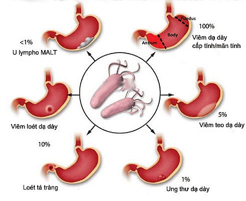 
Hình 5: Diễn tiến từ nhiễm vi khuẩn HP đến các bệnh lý dạ dày, trong đó có u MALT
