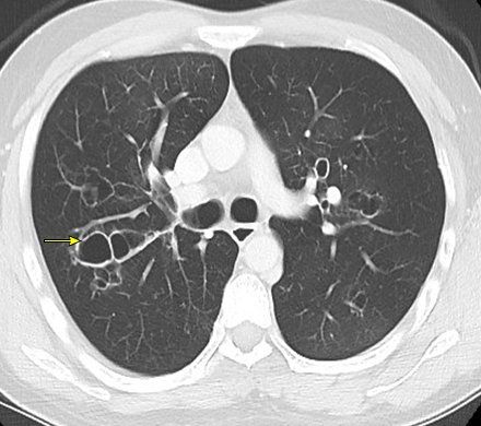 Computed tomography image of bronchiectasis