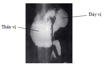 
Hình 20: X quang dạ dày cản quang TVKH gây biến chứng xoắn dạ dày
