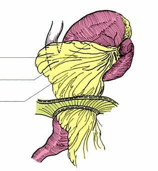 
Hình 5: Thoát vị khe hoành loại IV khổng lồ. Nguồn: Jacques Perissat, (2004)
