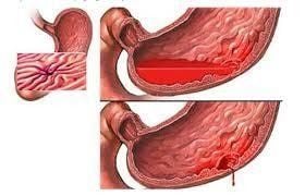 
Hình 1: Xuất huyết tiêu hóa – nguyên nhân thường gặp của các bệnh lí cấp cứu
