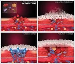 
Hình 11: Cơ chế cầm máu của Hemospray: gắn kết vào vùng chảy máu, tạo nên cơ chế cầm máu cơ học, đồng thời tập trung tiểu cầu và hoạt hóa các yếu tố đông máu, đẩy mạnh quá trình hình thành cục máu đông (Nguồn:hemospray.cookmedical.com)
